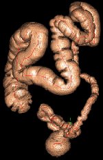 VIRTUAL COLONOSCOPY