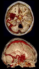HEAD (BRAIN AND VESSELS)
