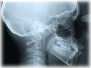 X-Ray of Head